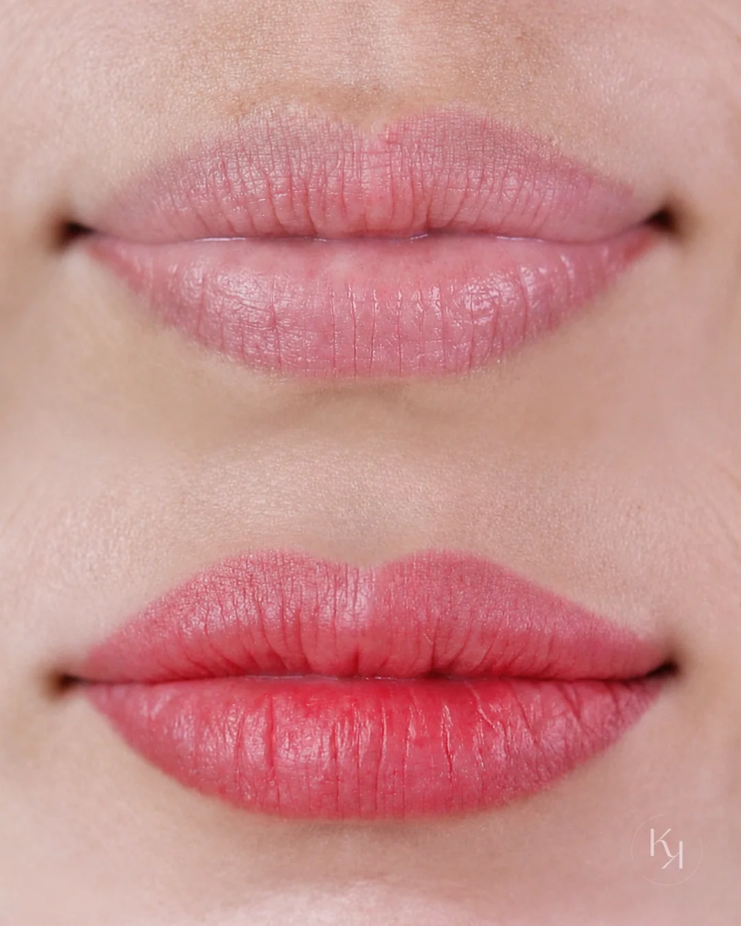 Antes e depois de lábios com a técnica Pure Lips